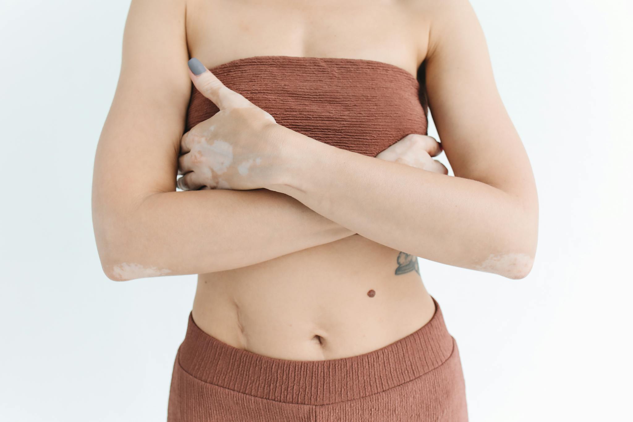 Midsection view of a woman with vitiligo, wearing brown attire, against a white background.